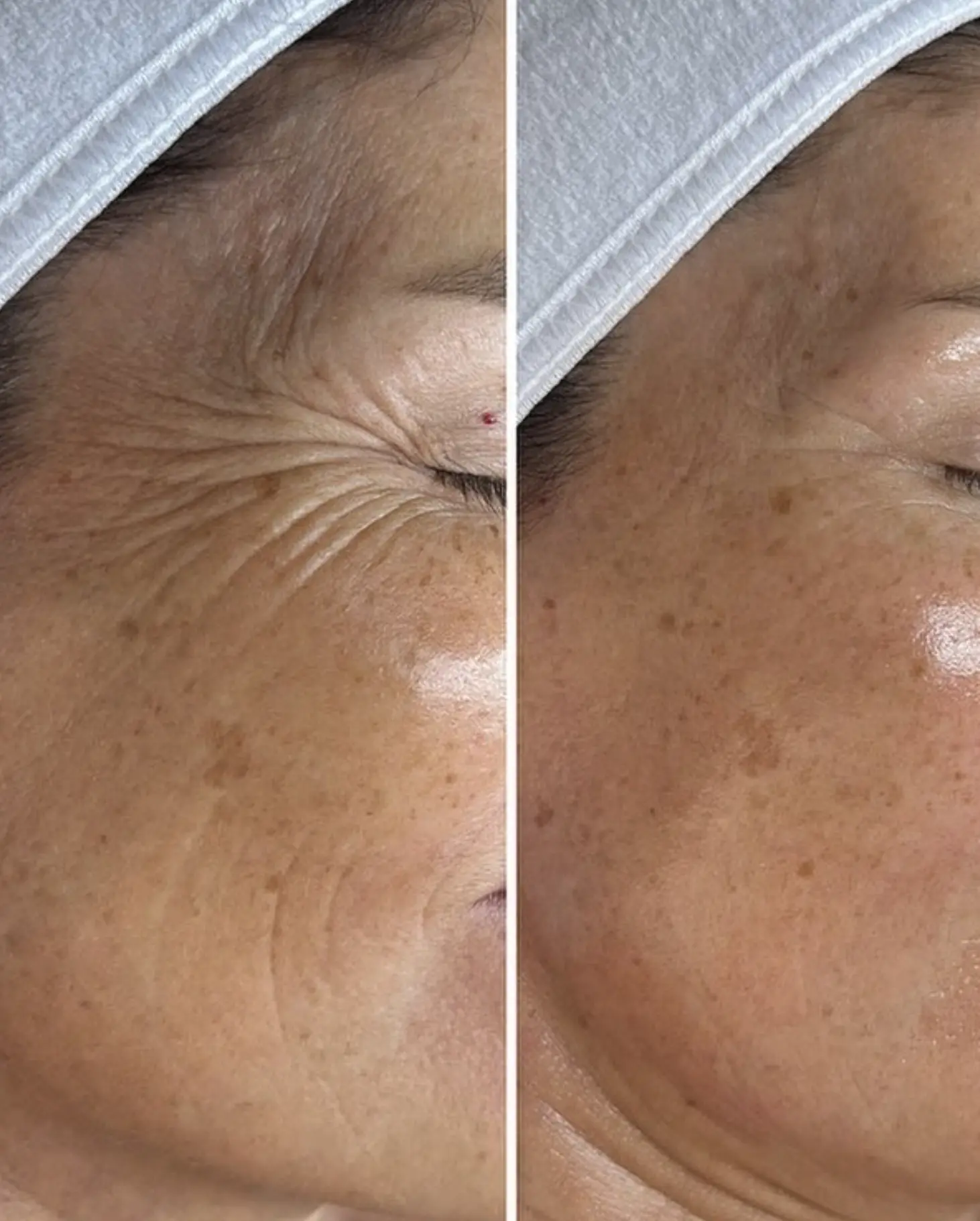hydrafacial Brisbane